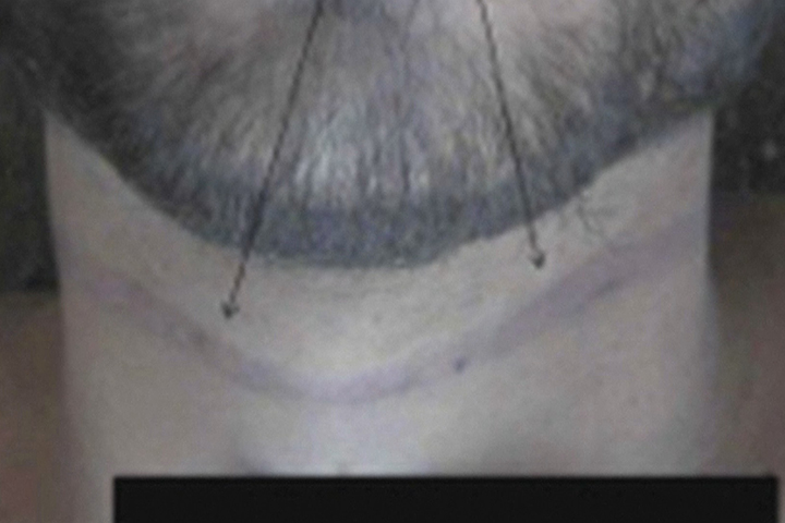 A transverse ligature mark across the anterior surface of the neck of man allegedly killed while in Syrian detention.