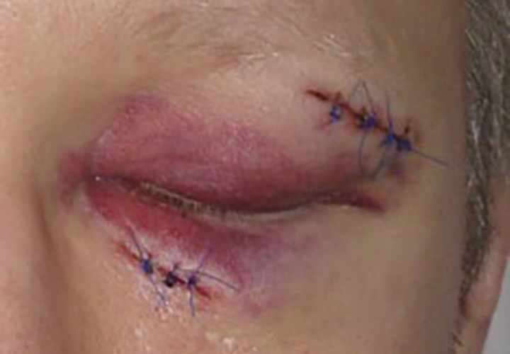 A nurse was attacked at Abbotsford Regional Hospital over the weekend, says the BC Nurses’ Union.