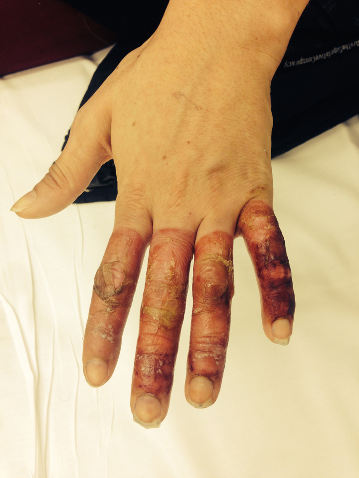 The good news is that her hands are healing and that it looks like she will be able to keep her fingers.