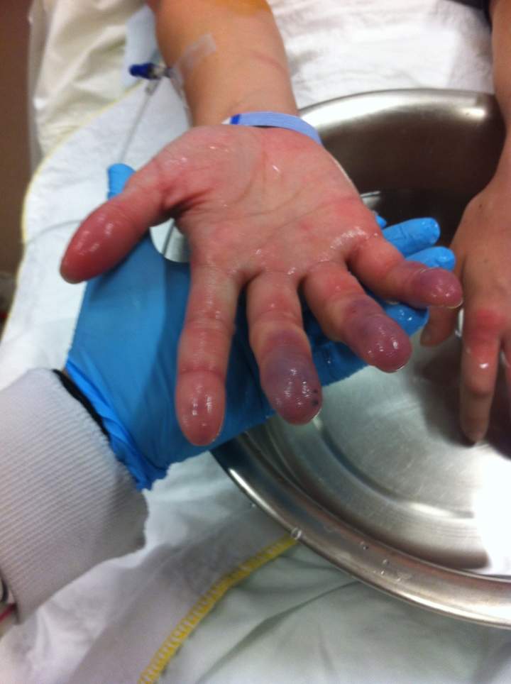 Australian Emma Quirk documented the painful experience of severe frostbite.