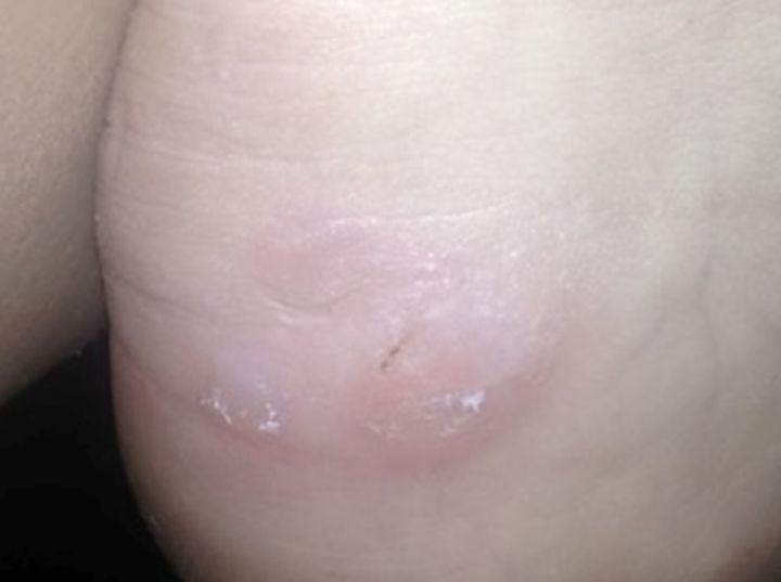 High heels pain