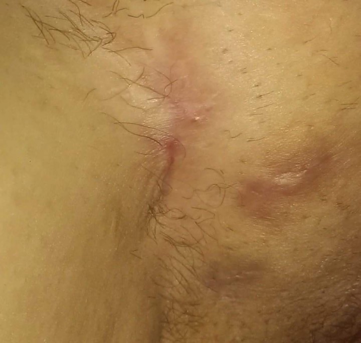Mandy Tarala’s Hidradenitis Suppurativa after healing with medical marihuana.