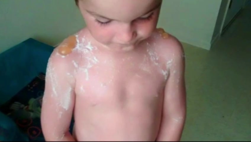 Mother blames daycare after young boys suffer horrific sunburns - image