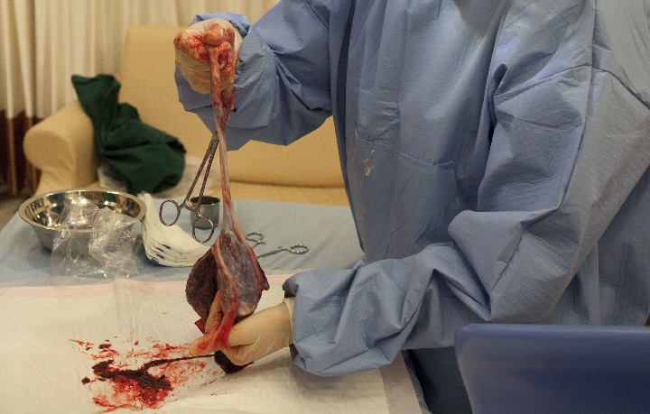 In a photo taken on February 20, 2012 a doctor holds a placenta in the delivery room of a hospital in Beijing. The health-giving qualities of placenta are currently creating a buzz in Western countries, where some believe it can help ward off postnatal depression, improve breast milk supply and boost energy levels. But placentophagy, the practice of eating one's placenta after birth, is relatively common in China, where it is thought to have anti-ageing properties, and dates back more than 2,000 years.