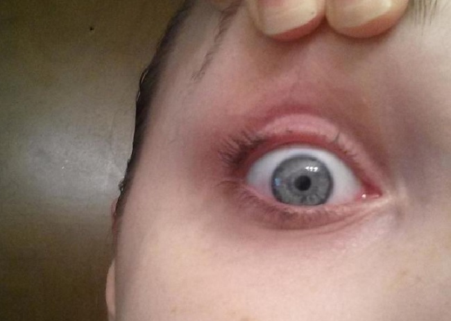 Eyelash curler nightmare: Woman’s sneeze leaves her lashless - image