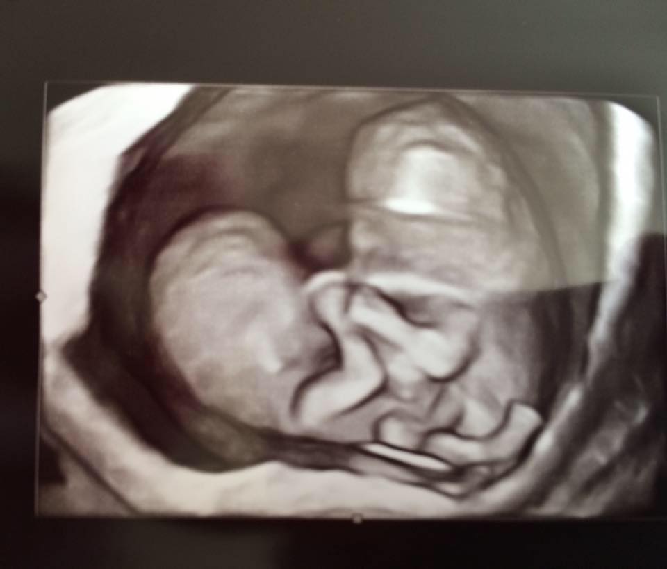 After seeing this image, doctors delivered fateful news to expectant mom Chelsea Torres: she was having conjoined twins.