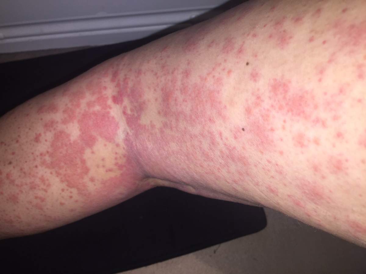 What one woman thought to be razor burn turned out to be a symptom of cancer.