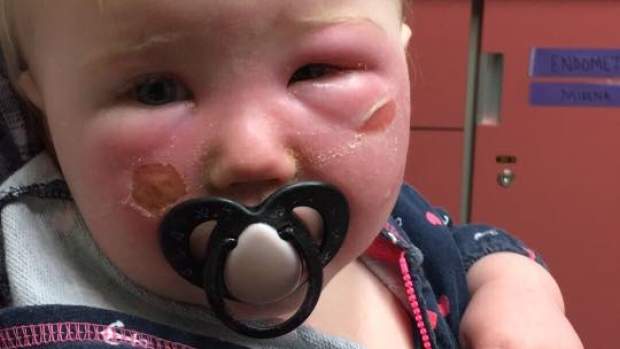 Saskatoon woman blames Banana Boat sunscreen for severe blisters - image