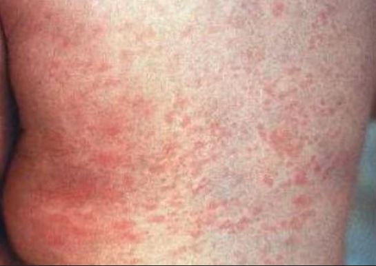 Nova Scotia Health Public Health is investigating a confirmed case of measles in the Halifax Regional Municipality area.