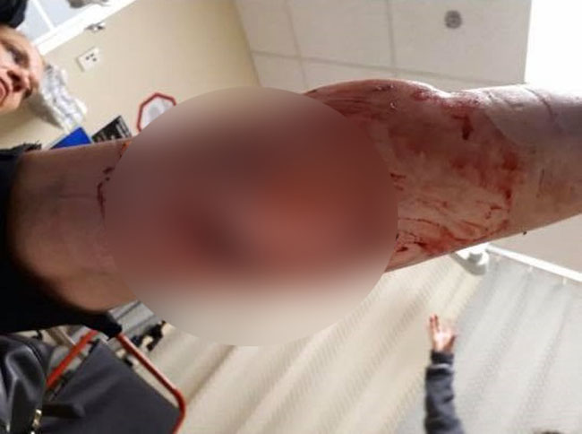 A Mission woman needed 85 staples in her leg to close wounds from a dog attack in Langley Tuesday night.