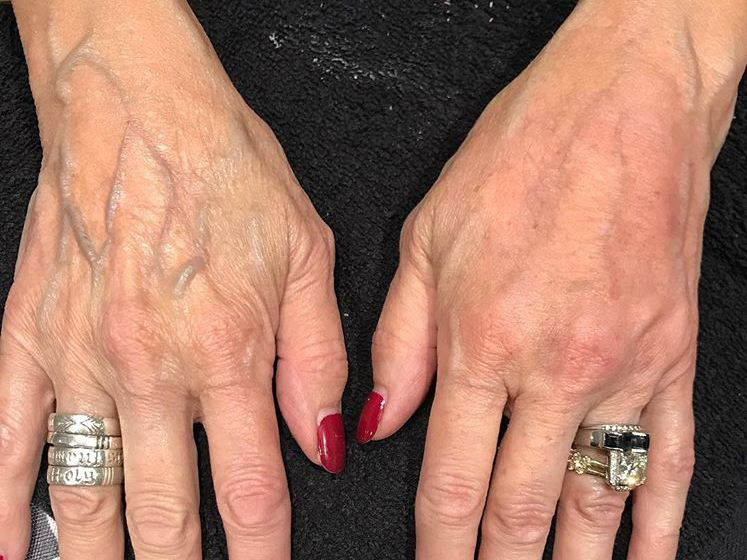 A before and after shot using Radiesse dermal filler.