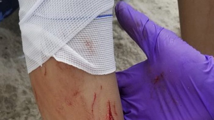 A first responder treats the leg of Lola Pollina, 12, after a suspected shark attack on Sailors Haven beach on Wednesday, July 18, 2018, at the Fire Island National Seashore in New York.