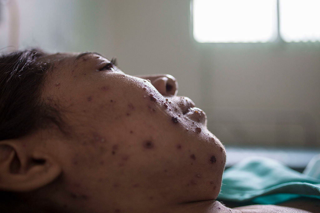Measles, a highly contagious infection caused by the measles virus is an airborne disease which spreads easily through the coughs and sneezes of those infected .