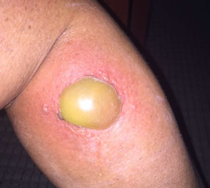 Jackie Gilluley said she had been stung by wasps many times before and never had a reaction.