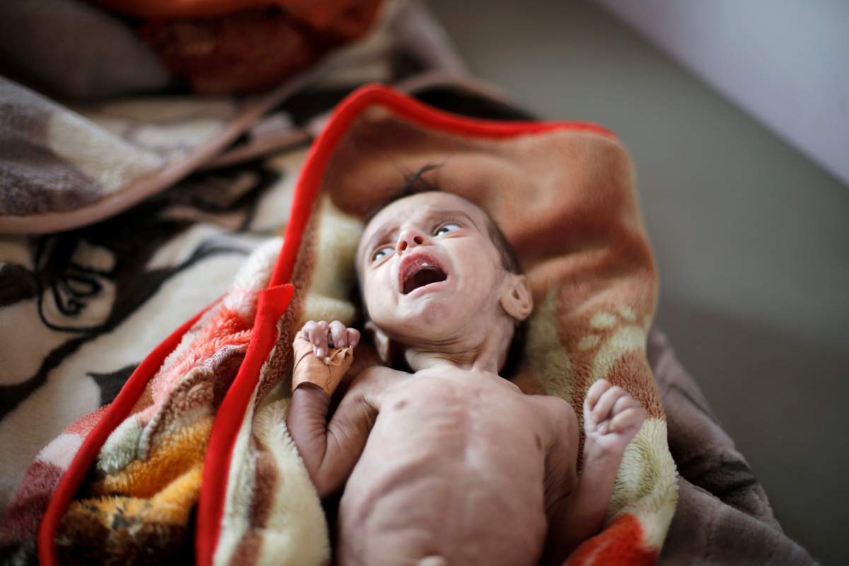 A malnourished boy lies on a bed at the malnutrition ward of al-Sabeen hospital in Sanaa, Yemen September 11, 2018. Picture taken September 11, 2018. 