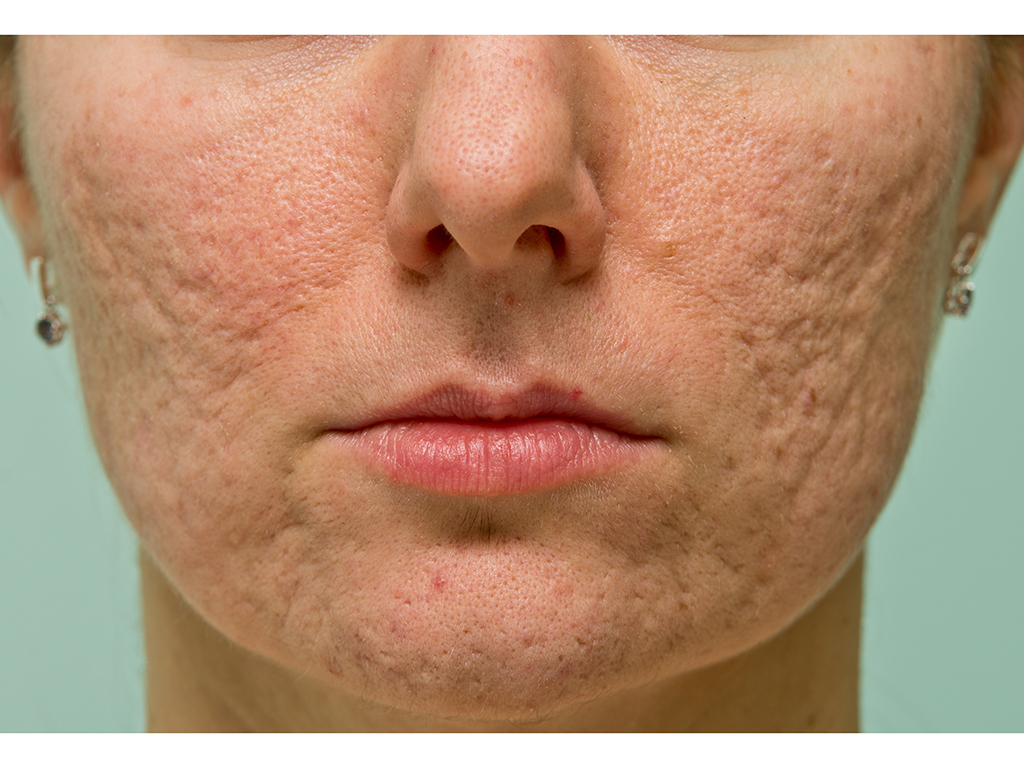 Acne scars form when inflammation causes changes in your skin's collagen. But they're not necessarily irreversible. 
