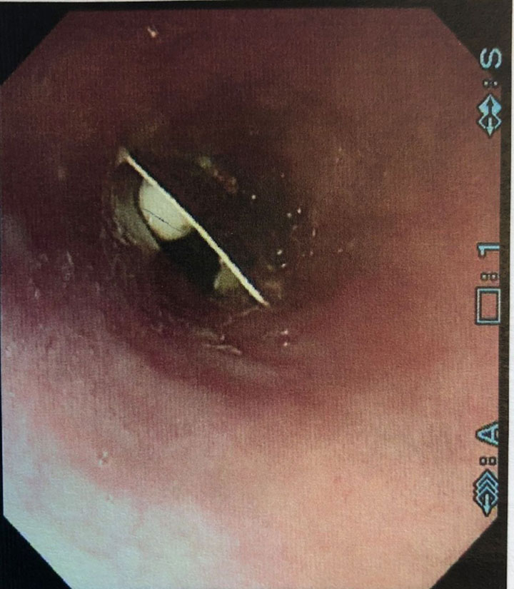 Endoscopic image of a packet of pills lodged in a woman’s throat.