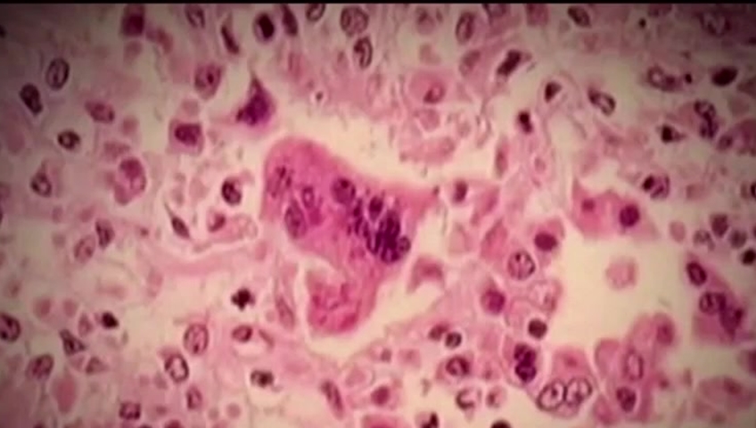 Measles infections can cause long-lasting damage to the body's immune system, according to new research.