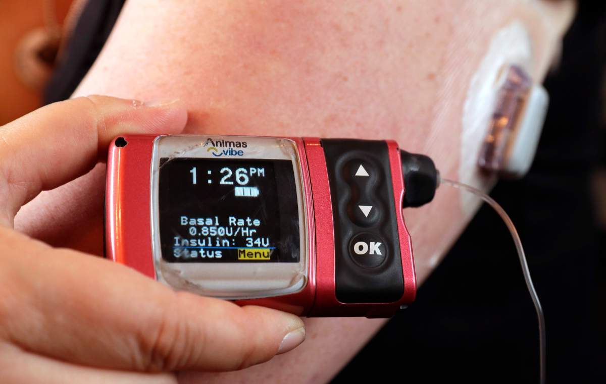 In this Tuesday, June 7, 2016, photo, Stephanie Rodenberg-Lewis holds her Animas Corp. insulin pump at her home in Katy, Texas.  