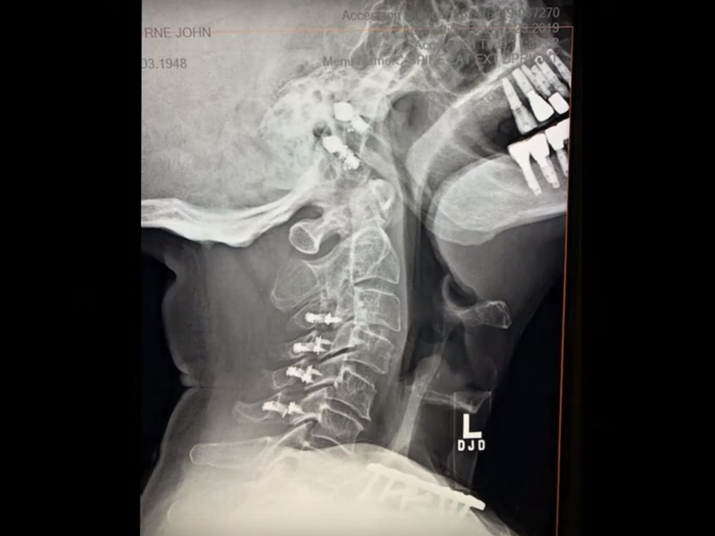 An x-ray scan of Ozzy Osbourne’s neck from 2019, after he suffered injuries from a fall in his Los Angeles, Calif., home in January.