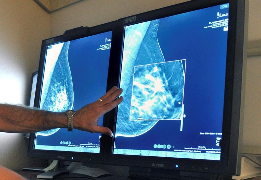 FILE - This July 31, 2012, file photo shows a mammogram, a test to detect cancer.