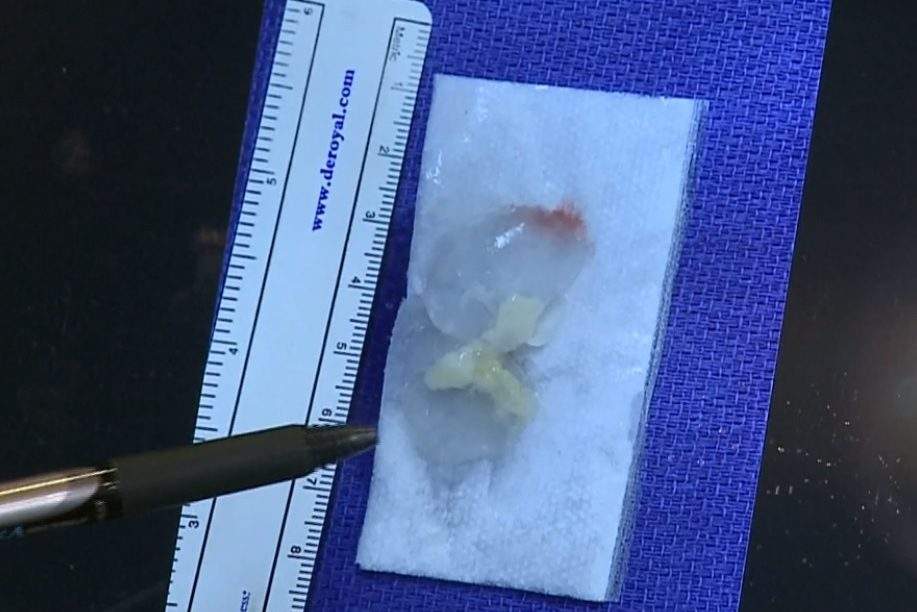 Doctors show the remains of a tapeworm removed from a patient’s head in Elgin, Texas.