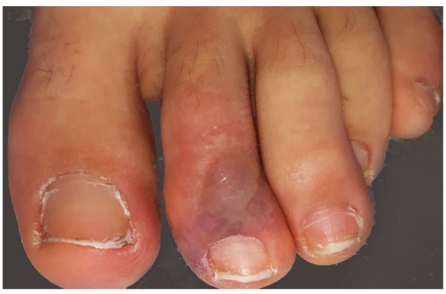 A photo of a blistered toe taken from an Italian case report of a teenager with COVID-19.