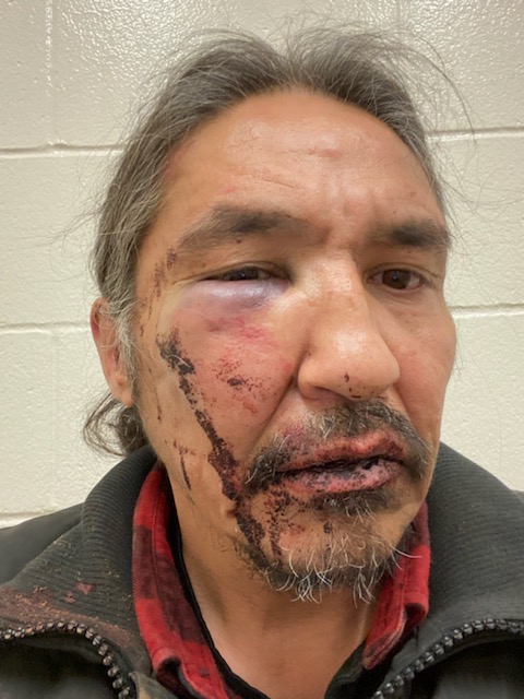 Chief Allan Adam of the Athabascan Chipewyan First Nation said Saturday that these lacerations and bruises were the result of a beating from RCMP officers in Fort McMurray, Alta. Chief Adam says this photo of him was taken after he was released from jail on March 12.
