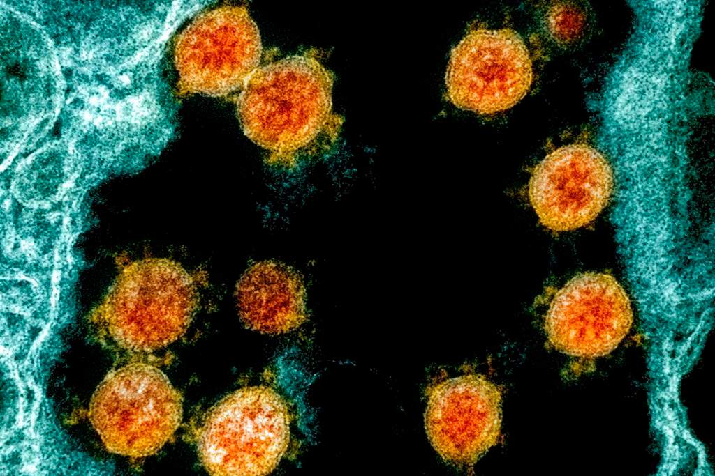 This electron microscope image made available and color-enhanced by the National Institute of Allergy and Infectious Diseases Integrated Research Facility in Fort Detrick, Md., shows Novel Coronavirus SARS-CoV-2 virus particles, orange, isolated from a patient. THE CANADIAN PRESS/AP-NIAID/National Institutes of Health via AP.