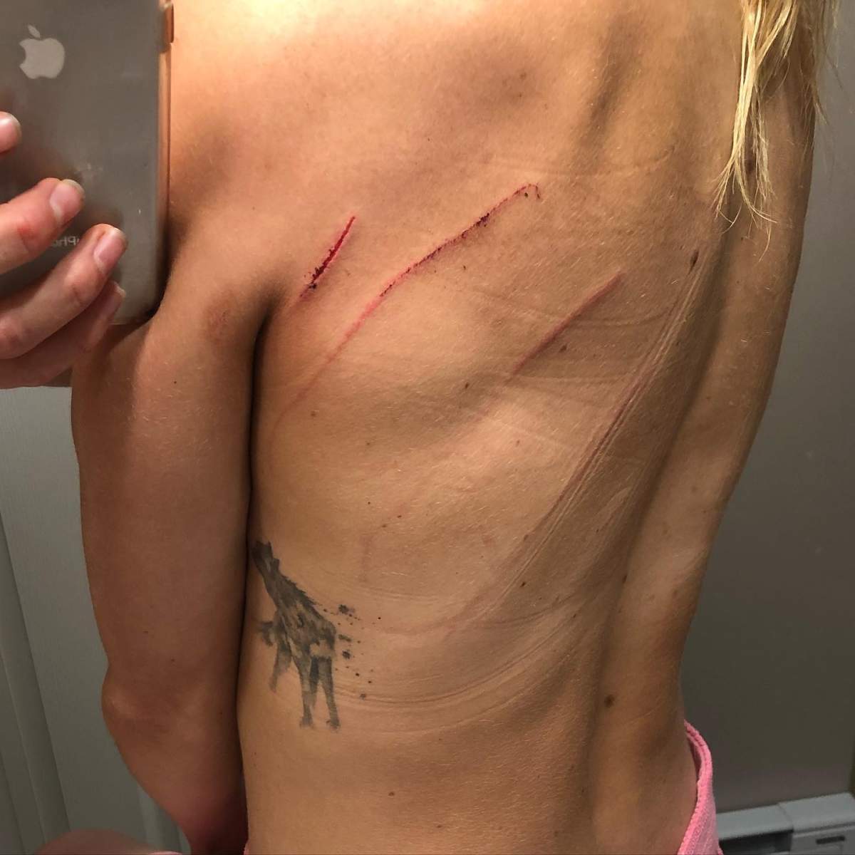The bear left claw marks on McKenzie’s back.