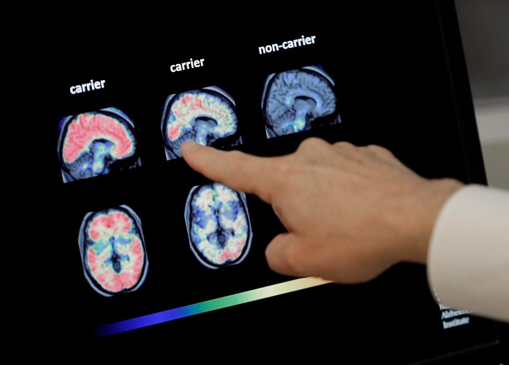 In this file photo, a doctor looks at PET brain scans.