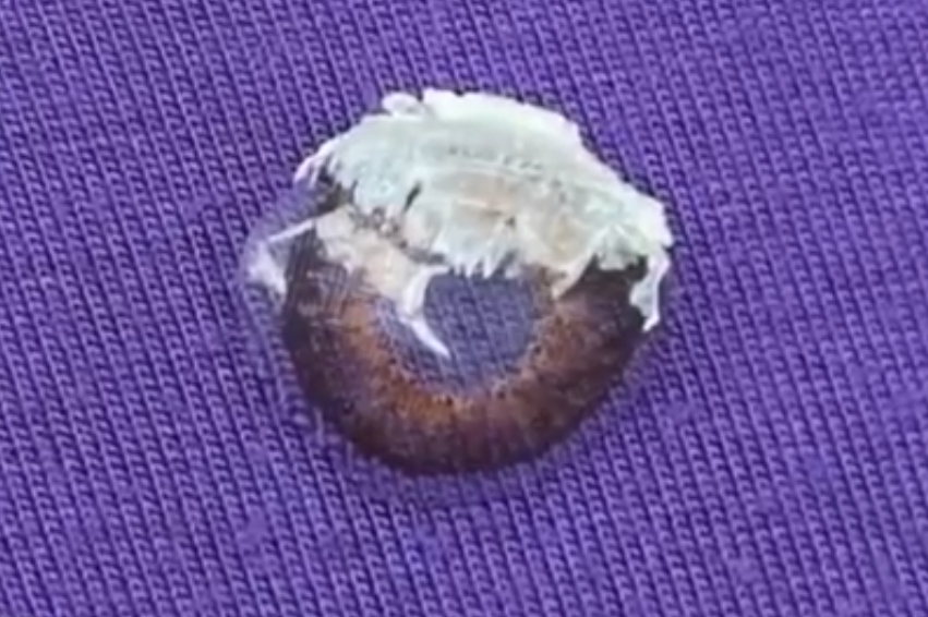 Yacedrah Williams' glue-encrusted contact lens is shown after it was removed from her eye in Michigan in April 2021.