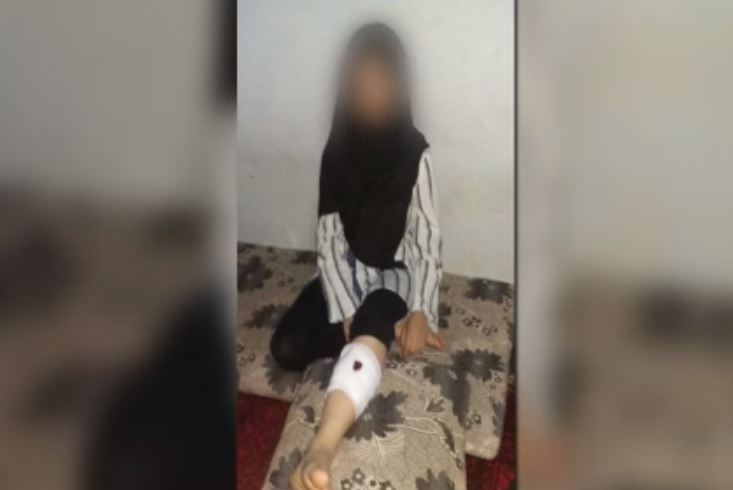 Shiba Mohammadi’s sister who was struck by a bullet in the leg in July of 2021 during fighting between the Taliban and Afghan military.