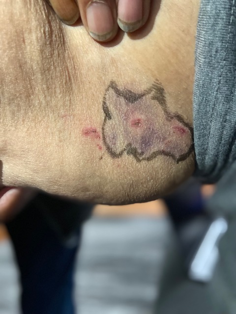 Thomas Favel’s bruises from the alleged assault at Regina General Hospital