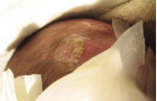 An infant with lesions on their scalp as the result of a sexually transmitted infection.