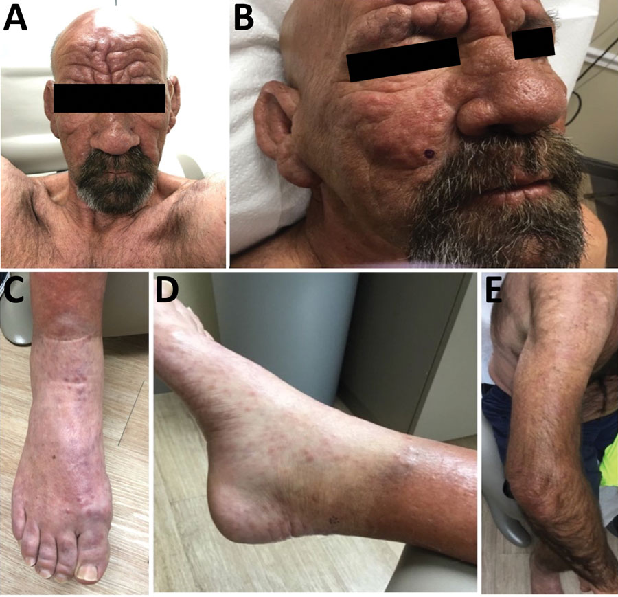 epromatous leprosy in a 54-year-old man in central Florida, USA, 2022. A, B) Leonine facies with waxy yellow papules. C) Violaceous nonblanching macules coalescing into patches along dorsum of feet bilaterally. D, E) Erythematous papules coalescing into plaques along extensor aspects of upper and lower extremities bilaterally.