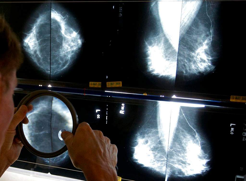 Leaked emails show Sask. breast cancer patients can't afford Calgary for care