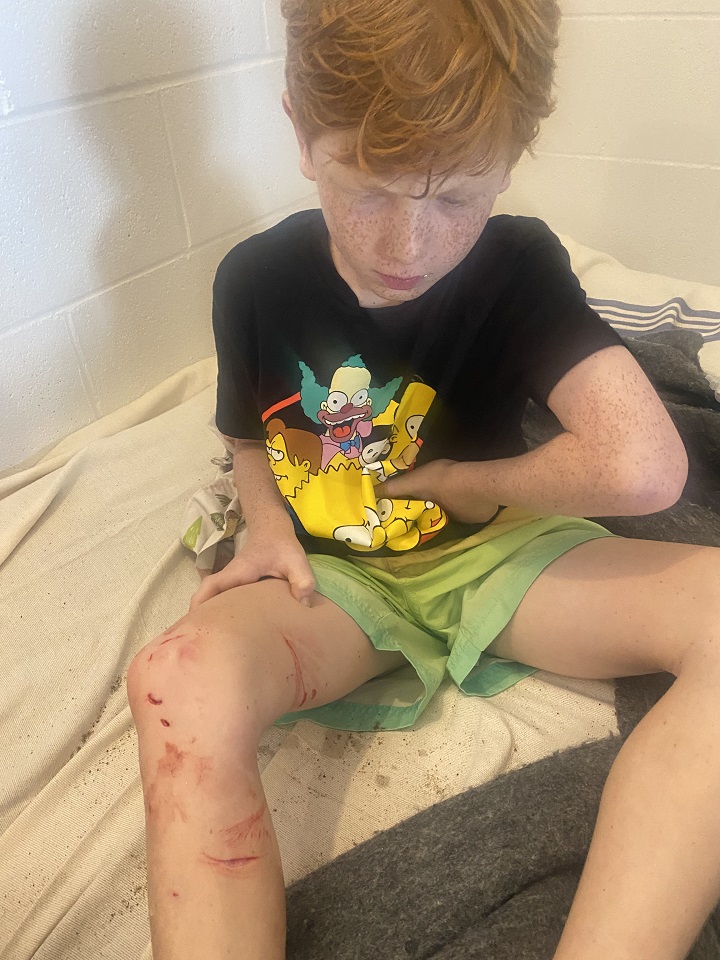 Max Mandl shows the injuries he sustained during a swim at Jean-Doré beach at the end of June 2024. Courtesy Mandl family