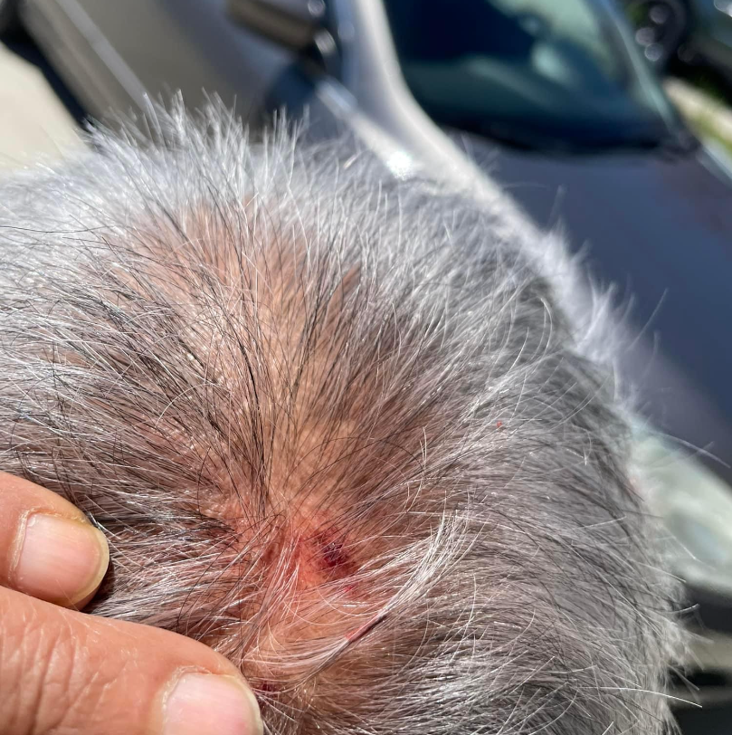 Hawk attack injury