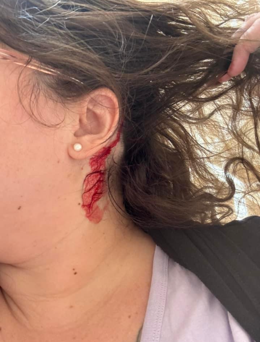 Hawk attack injury