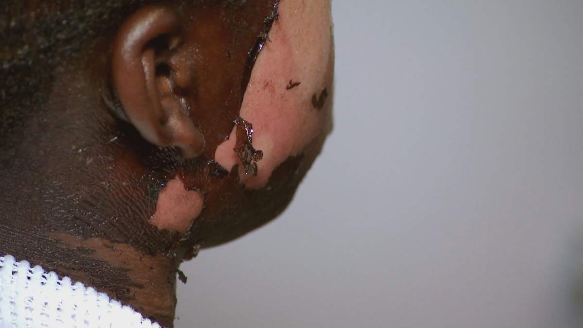 A 10-year-old boy from Longueuil, Que., had boiling water thrown on him while walking home from school on Oct. 2. Police have arrested a woman in connection with the attack.