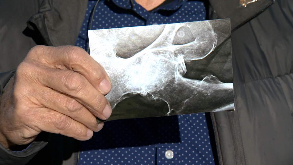Heninger shows off an x-ray photo of his hip that he said was badly damaged when he managed to fight off an attack by Shabaz Ahmed.